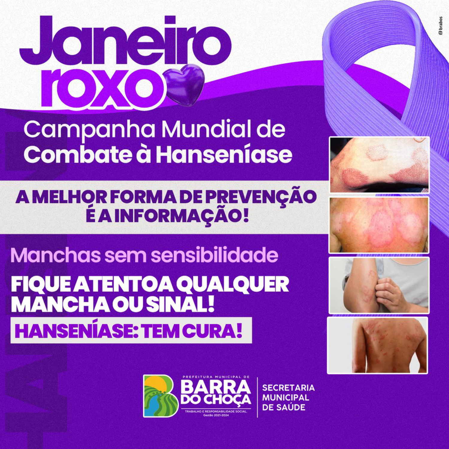 Janeiro Roxo: mês da Campanha Mundial de Combate à Hanseníase